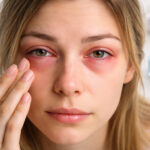 Cosa può essere quando si gonfiano gli occhi? Cause, rimedi, farmaci e segnali da non trascurare