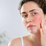 Guance rosse: cause, rosacea, pressione alta e rimedi