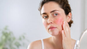 Scopri di più sull'articolo Guance rosse: cause, rosacea, pressione alta e rimedi