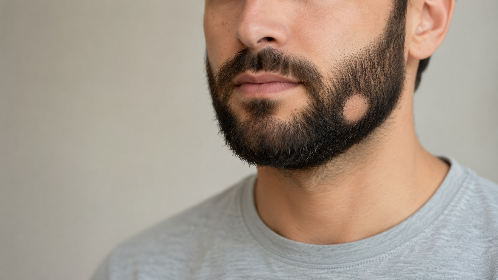 Al momento stai visualizzando Alopecia della barba: cause, durata, cure e rimedi naturali